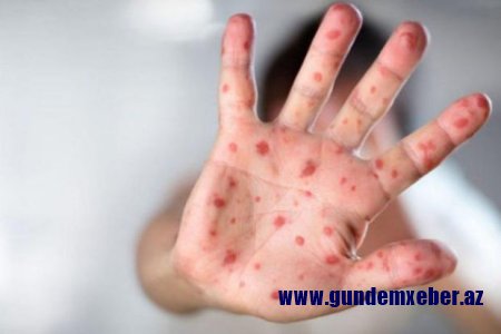 Nazirlik qızılcaya yoluxma ilə bağlı epidemioloji vəziyyəti AÇIQLADI